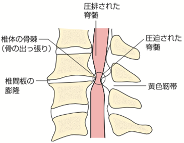 椎間板の膨隆や椎体の骨棘、黄色靭帯の肥厚などによって、脊柱管が狭くなり脊髄が圧迫されている