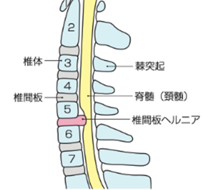 頚椎の構造と椎間板ヘルニア