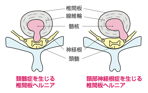 頚髄症を生じる椎間板ヘルニア、頚部神経根症を生じる椎間板ヘルニア