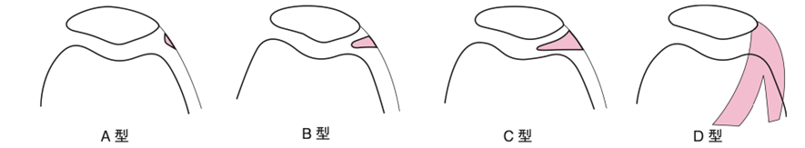 図：関節鏡による分類(榊原の分類)