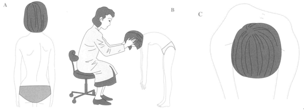 A.検診などで外観から側弯をチェックする方法
B.前屈位で肋骨隆起をチェックする方法
C.典型的な背部の肋骨隆起
