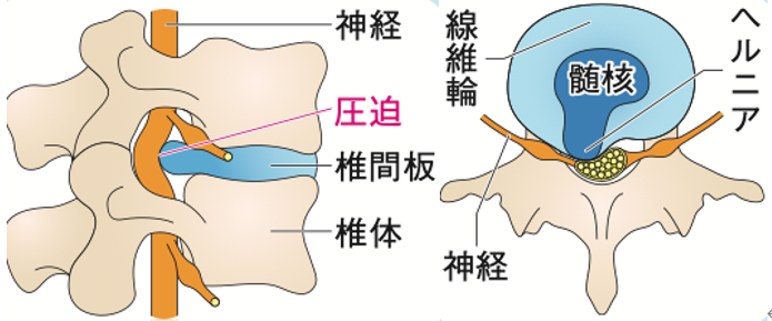 椎間板が後方に突出して、硬膜(神経の管)を圧迫する様子