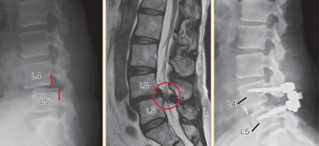 腰部脊柱管狭窄症(腰椎変性すべり症)の手術