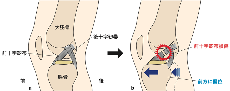 前十字靭帯損傷 正常(a)→受傷時(b)