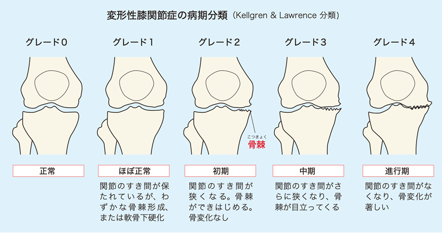 変形性膝関節症の病期分類｜【グレード0：正常】【グレード1：ほぼ正常】関節の隙間が保たれているが、わずかな骨棘形成、または軟骨下硬化。【グレード2：初期】関節の隙間が狭くなる。骨棘ができはじめる。骨変化なし。【グレード3：中期】関節の隙間がさらに狭くなり、骨棘が目立ってくる【グレード4：進行期】関節の隙間が無くなり、骨変化が著しい