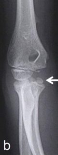 上腕骨内側上顆骨折(b-c): 骨片は腕尺関節に嵌頓している