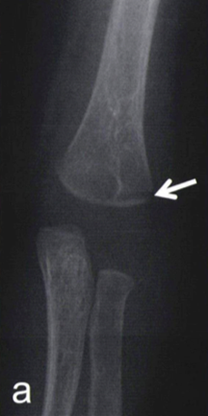腕骨遠位骨端線離開(a):上腕骨小頭の骨端核は未出現です
上腕骨遠位骨端外側部に骨折線(Thurstan-Holland sign陽性=矢印)を認めます