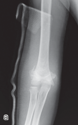 図：上腕骨顆上骨折のレントゲン写真