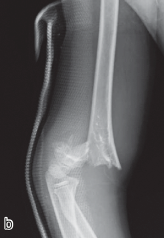 図：上腕骨顆上骨折のレントゲン写真
