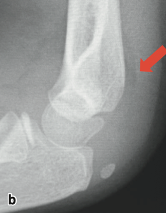 図：骨折部にずれのない骨折
(b.側面像：骨折線ははっきりとしないが、黒い透亮像(⇨)が後方に張り出している