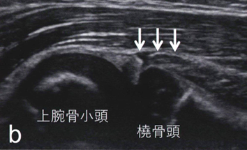 肘内障(b):輪状靭帯と一緒に回外筋が引き込まれている
Jサインと呼ばれ、肘内障の特徴的なエコーの像