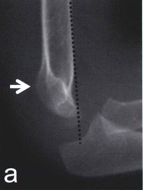 上腕骨顆上骨折(a-c)：側面像で、上腕骨小頭はこの線より後に位置してしまっている
