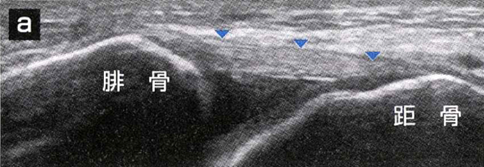 健側の前距腓靭帯：靭帯(▼)は連続性がありfibrillar patternを呈している