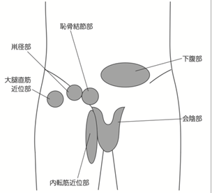 スポーツ選手に発生する鼠径部周囲痛