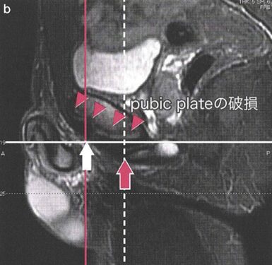 恥骨結合のpubic plateの破綻