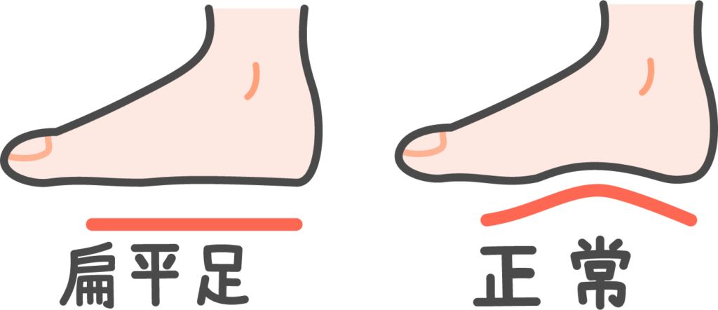 扁平足