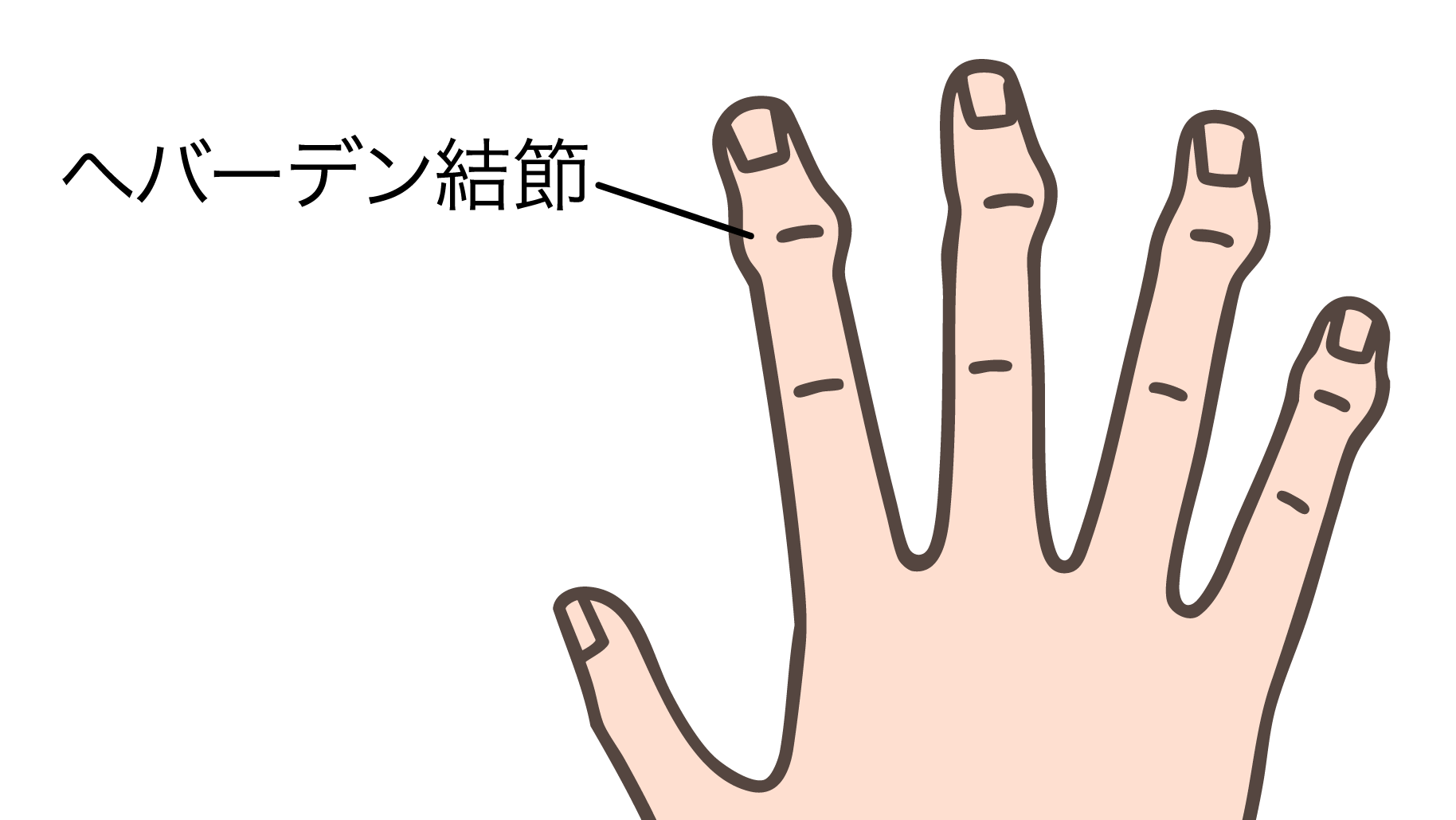 へバーデン結節