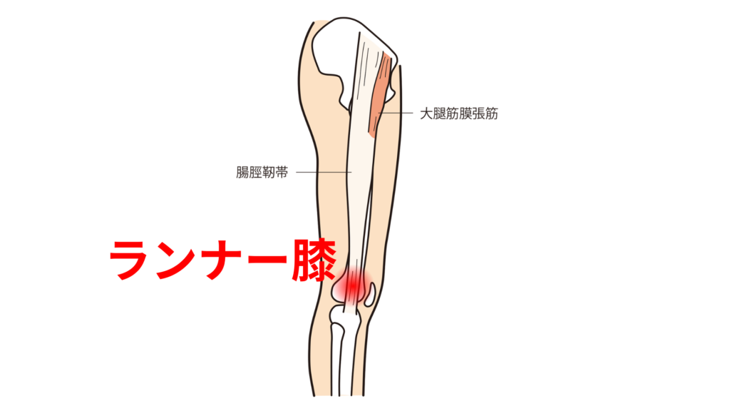 ランナー膝