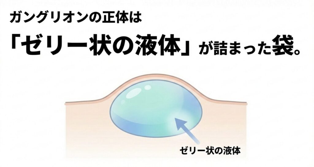 ガングリオンの正体