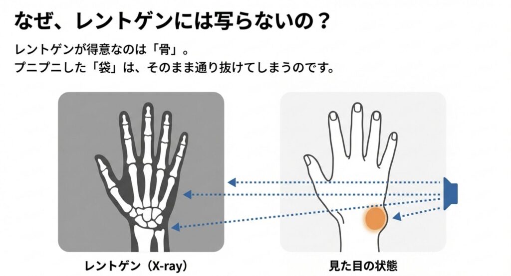 ガングリオンはなぜレントゲンで写らないの？