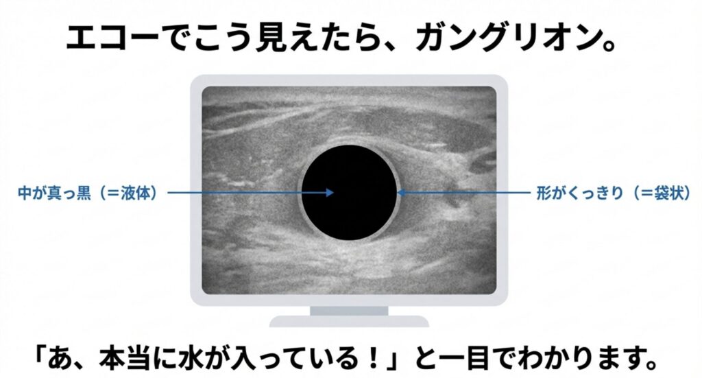 ガングリオンの見え方